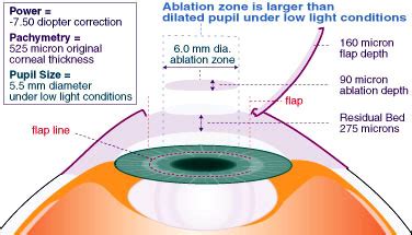 thick cornea measurement a 6|minimum corneal thickness for lasik.